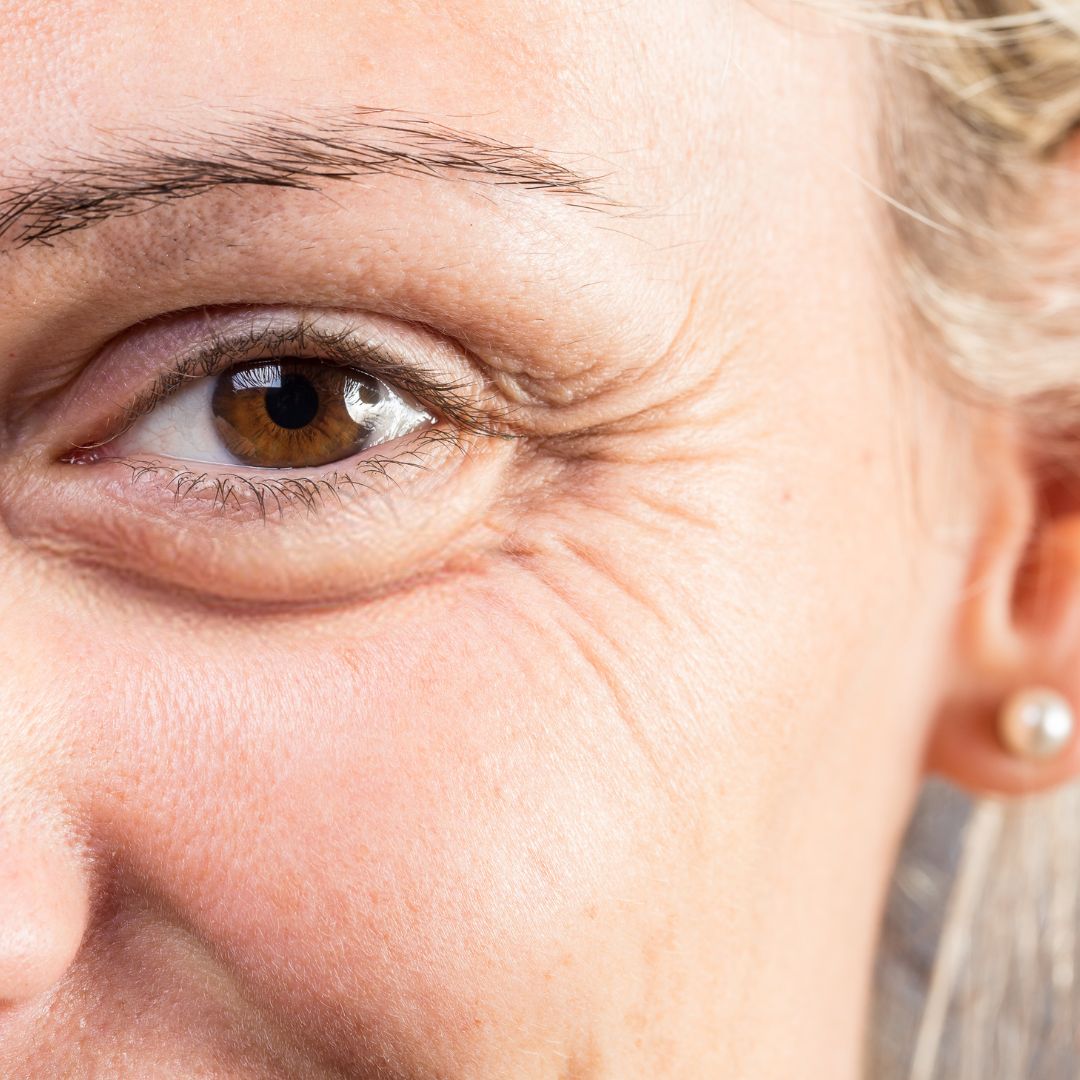 wrinkles around a woman's eye